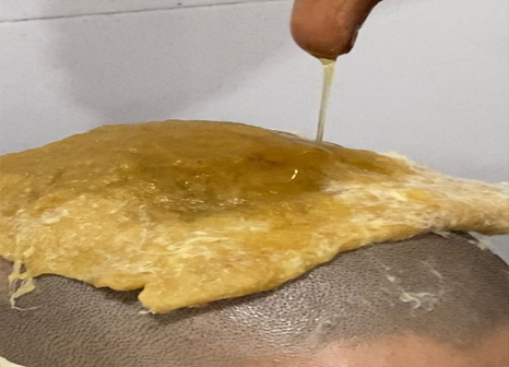 Shiropichu head treatment at Marsha Ayurvedam