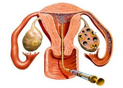 Uttar Vasthi treatment at Marsha Ayurvedam