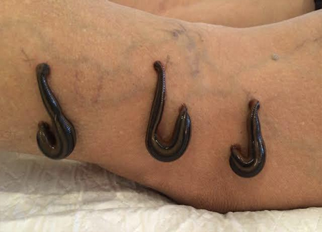 Leech therapy treatment at Marsha Ayurvedam