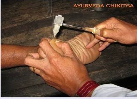 Agnikarma heat therapy at Marsha Ayurvedam